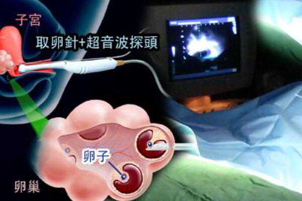广东省妇幼保健院做三代试管婴儿从进周到移植大约多少钱？