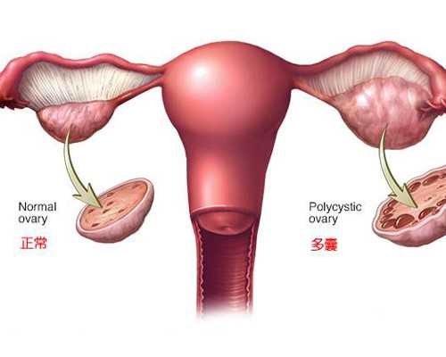 找人代怀孩子，黄体酮凝胶排出豆腐渣正常吗