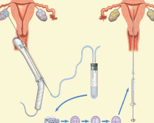 珠海借卵,珠海试管做一对龙凤胎的费用大概是多少钱?