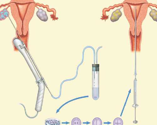 泰国试管婴儿为什么要做染色体筛查?